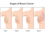 Stages of Breast Cancer with sub-stages