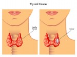 Treatments and Staging of Thyroid Cancer