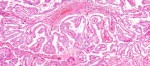 Thyroid Cancer Signs, Symptoms and Types