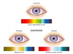 What is Color Blindness? Causes and Symptoms