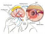 Migraine Headache Overview and Its Different Types